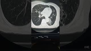 Bilateral bronchiectasis on CT scan CT scan chest interpretation [upl. by Ellehcar]