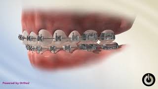 David Ross Orthodontics Elastics  How to wear Crossbite Rubber bands [upl. by Nojad]