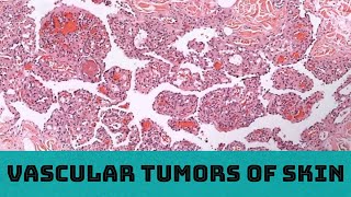 Vascular Tumors of Skin 31 cases in 3 hours Board Review for Pathology Dermatology Dermpath [upl. by Anavi741]