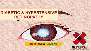 Diabetic amp Hypertensive retinopathy [upl. by Alicul]