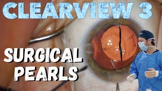 Cataract Surgery Pearls with the Clearview 3 Lens Implant [upl. by Anyotal486]