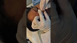 Retirada de sinal do nariz Nose mole removal [upl. by Pleione]