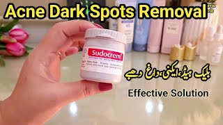 Acne Dark Spots On Face Removal Treatment Plus Blackhead Removal Clear Skin Cream [upl. by Ikairik]