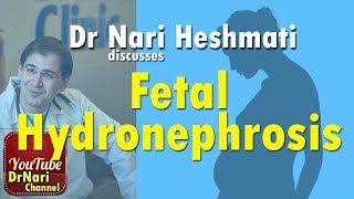 Fetal Hydronephrosis also known as pyelectasis or pelviectasis Discussed by Dr Nari Heshmati [upl. by Ingraham]