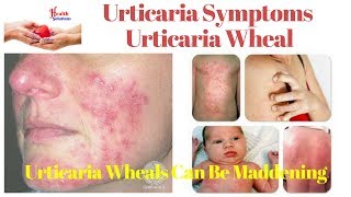 Urticaria Symptoms  Urticaria Wheal  Urticaria Wheals Can Be Maddening 😛 [upl. by Yerok]