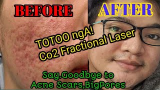 co2 fractional laser  totoo nga sya😍 Honest Review 2021 [upl. by Hakim]