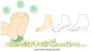 Onychomycosis  What is it and how is it treated [upl. by Enneyehs]