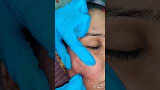 SUBCISION WITH MICRO NEEDLING RF FOR ACNE SCAR [upl. by Aneral152]