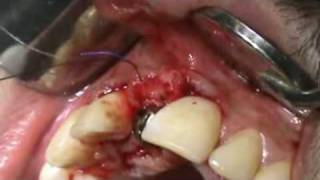 3i Implant placement in the aesthetic zoneafter EASY GRAFT socket preservation [upl. by Netsirhk]