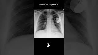 Implantable cardioverter defibrillator 164 Cardiac disease chest xray Quiz radiologychannel007 [upl. by Harad953]