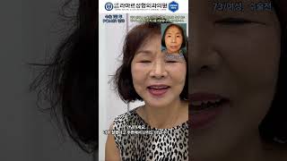 모영웅 대표원장님 풀페이스 안면거상Extended deep plane dual layer full facelift 수술결과 수술 1달차 영상 [upl. by Zetnom761]