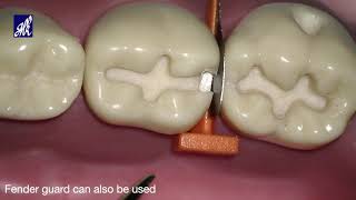 Cavity Preparation Series Class II [upl. by Annetta]