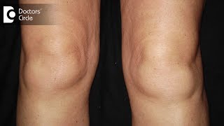 What are the causes of swelling in knees  DrNagesh HS [upl. by Ardnaz65]