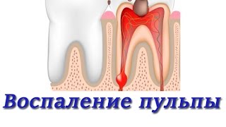 Лечение зубов Воспаление пульпы Методы лечения Терапевтическая стоматология [upl. by Maddis]