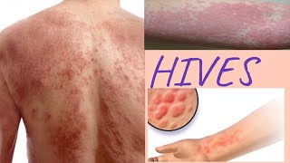 HIVES causes  Natural remedies to get rid of hive at home [upl. by Rowen824]