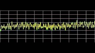 Rheumatoid Arthritis  Rife Frequencies [upl. by Fabiola]