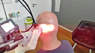 Scalp laser hair removal  11 treatment  05092022 [upl. by Torrie]