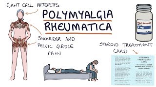 Polymyalgia Rheumatica Visual Explanation for Students [upl. by Sewell]