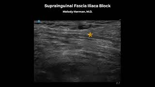 Suprainguinal Fascia Iliaca Block [upl. by Htiel]