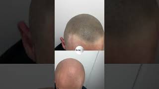 Cura o tratamiento para la ALOPECIA 🧑‍🦲🔥 [upl. by Otter477]