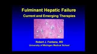 Fulminant Hepatic Failure Current and Emerging Therapies [upl. by Einre]