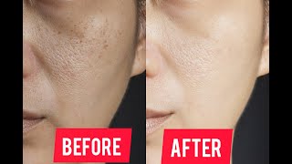 open pores home remedy  dark spots beautytips [upl. by Tesil]