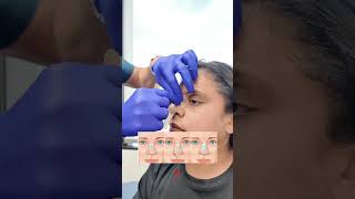 Nose Taping After Rhinoplasty  Raja Mohan M D shorts shortsvideo [upl. by Elconin]