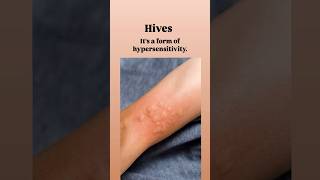 What Are Hives HivesUrticariaAllergyReliefSkinCareChronicHivesItchySkin [upl. by Enovahs648]