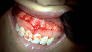 Lip Reduction Using ErCrYSGG Laser [upl. by Lihcox]