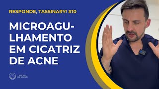 Microagulhamento em cicatriz de acne  Responde Tassinary 10 [upl. by Morris779]