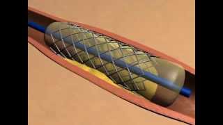 ballonnet et stent  angioplastie coronaire percutanée [upl. by Rizzi]