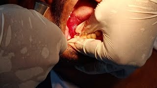 Lower wisdom tooth extraction subscribe support like [upl. by Yrrem]