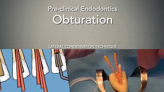 Obturation Lateral Condensation Technique [upl. by Lah]