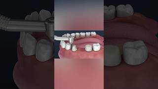 Tooth supported fixed bridge of 3 teeth medicalanimation health dentist [upl. by Aronal]