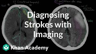 Diagnosing strokes with imaging CT MRI and Angiography  NCLEXRN  Khan Academy [upl. by Olly]