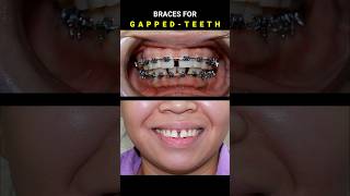 BRACES FOR GAPPED TEETH 32 MONTHS DURATION braces orthodontist dentist [upl. by Leira607]