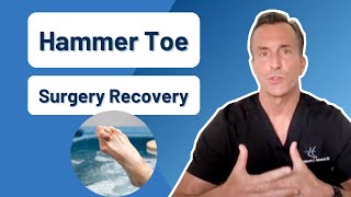 How Long Is Recovery From Hammer Toe Surgery [upl. by Eiltan]