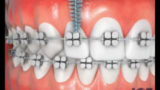 Interproximal Brush With Braces [upl. by Iahk]