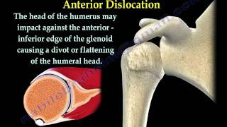 Shoulder Dislocations Everything You Need To Know  Dr Nabil Ebraheim [upl. by Wearing]