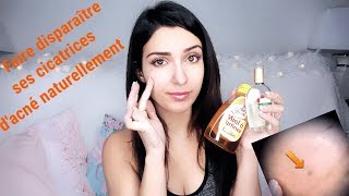 Comment faire partir les cicatrices dacné  astuce efficace et naturelle [upl. by Eliathas]