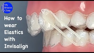 Using Elastics with Invisalign [upl. by Gardy246]