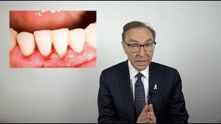 How to Treat Bleeding Gums at Home [upl. by Ahseirej]