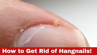 How to Get Rid of Hangnails Quick Fixes Revealed [upl. by Ahrens]