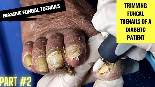 Massive Fungal Toenails  Trimming Fungal Toenails of a Diabetic Patient  Part 2 Podiatry [upl. by Notsob]