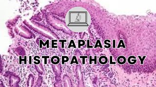 METAPLASIA  HISTOPATHOLOGY AND MORPHOLOGY [upl. by Hguh]