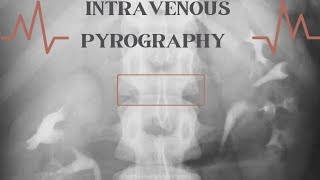 IVPIVU Intravenous UrographyPyelography IVU Procedure Diagnostic radiology [upl. by Enileme122]