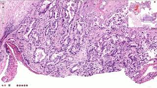 Adenocarcinoma of the Esophagus  Histopathology [upl. by Matilda]