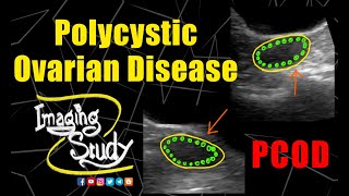 Polycystic Ovarian Disease  PCOD  Ultrasound  Case 187 [upl. by Summons]