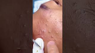 Huge Blackhead Extraction Extremely Satisfying [upl. by Matelda]