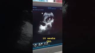 10 weeks CRLultrasound doctordoctors health hospitalpregnancy pregnant baby babygirl [upl. by Leroi966]